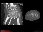 ostéonécrose post-traumatique du lunatum : TDM